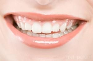 آموزش سفید کردن دندان‌