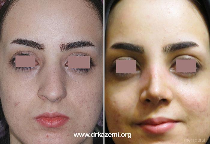 عکسهای قبل و بعد عمل جراحی بینی ایرانی