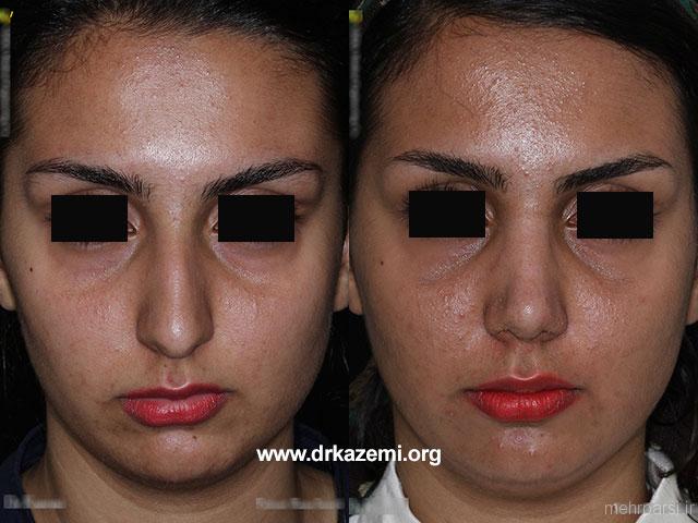 عکسهای قبل و بعد عمل جراحی بینی ایرانی