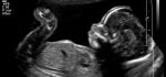 فیلم سونوگرافی از جنین و صدای قلب کودک برای اولین بار